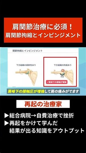 肩関節拘縮とインピンジメントについて#治療家#理学療法士#柔道整復師#肩関節