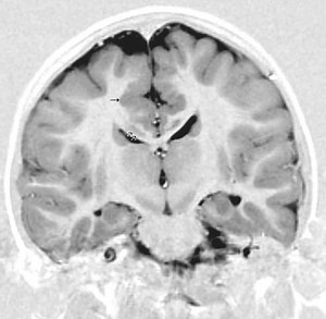 Gray matter heterotopia - Alchetron, the free social encyclopedia