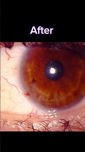 Pterygium surgery - before and after.