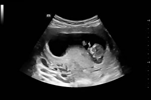 From Bump To Baby With your first NHS scan being further into your pregnancy now due to waiting lists it doesn’t mean you have to wait that long to see your precious baby. We are here at all stages of your pregnancy even if you just want to check in on your little one to see them grow or like here watch them playing away in your tummy. ❤️ Scans from just 6 weeks pregnant upto term. Book into our private clinic now: https://frombumptobaby.co.uk/book-now/ | My Omagh