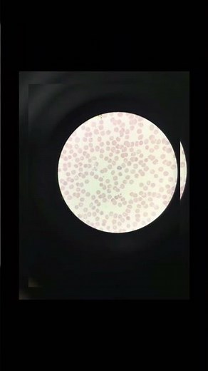 Plasmodium parasite examination under the microscope for accurate treatment #malaria #microscopy#lab