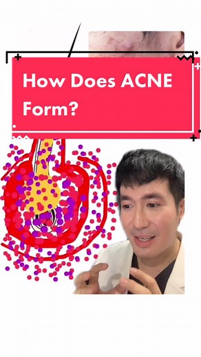 How Does ACNE Form? #learnontiktok #backtotiktokskwela #foryou #foryou #acne #healthtokph #tiktoku