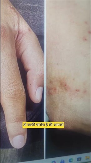 अगर आपको रात को खुजली होता है ~ Dr. Parag Sharma । Raksha Sutra #health #facts