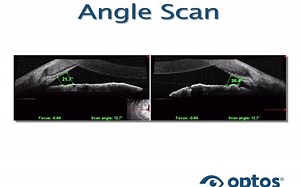 教学视频：带视野检测功能的Optos光学相干断层扫描与激光扫描检眼镜（Optos OCT SLO with MicroPerimetey）10.