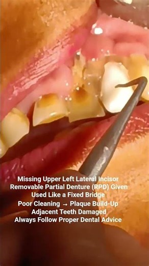 RPDUsedasFixedBridge How WrongDentureUseDamages Teeth#DentalAwareness #viralshorts#TheDentalGuru