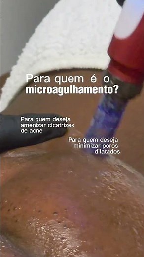 ✨ Microagulhamento: o tratamento que transforma a pele!Adeus acne, manchas, poros dilatados e rugas