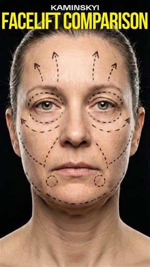 Edgar KAMINSKYI on Instagram: "Classical Facelift vs Endoscopic Facelift 💆🏻‍♀️ Two vectors. Two different philosophies of rejuvenation. In this video, I clearly demonstrate how the result changes depending on the chosen approach for the same facial type: a classical Deep Plane facelift versus an endoscopic Deep Plane facelift. The key difference you will see is not just in the scars or access points, but in the direction of tissue movement -the vector that defines the final look. The classical