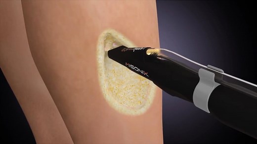 SonicVac - Vacuum Assisted Ultrasonic Wound Debridement System