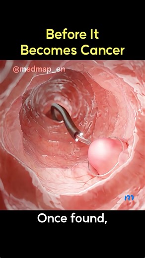 Before It Becomes Cancer