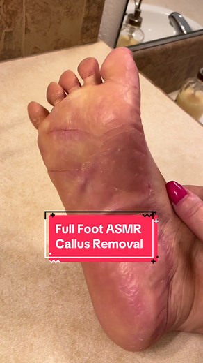 Relaxing ASMR Foot Callus Removal & Scratching | Podiatrist Treatment