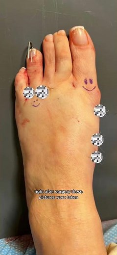 Bunion & Hammertoe Foot TRANSFORMATION!