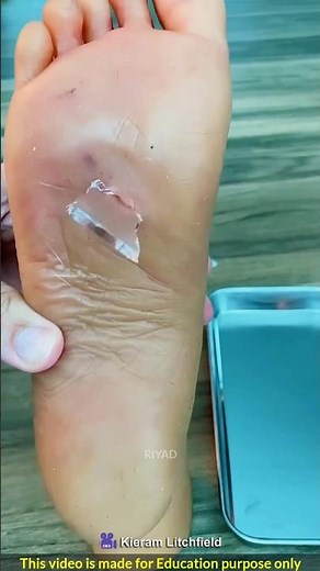 How to Safely Remove Glass from Your Foot😨