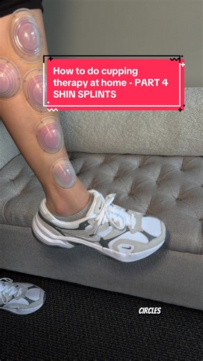 Notice how when the cups are taken off they actually SHOW your problem areas and where your stagnent blood is and tension! This treatment is my all-time favorite. This is part 4 of my “how to cup yourself” series where I show you how to do professional cupping techniques on yourself to relieve pain! These cups are linked in my bio, I’ve been using them for years and they’re my favorite for myself and my clients💯 Have you ever had shin splints?? #shinsplints #shinsplintmassage #runner #runnershi