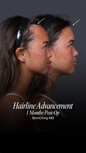 Dr. Shim Ching | Double Board Certified Plastic Surgeon on Instagram: "For patients who feel like their forehead or hairline throws off the balance of their face, hairline advancement can be a powerful change. This procedure gently brings the hairline forward, reducing forehead height and creating proportions that feel softer, more feminine, and more harmonious with the rest of the face. In this case, she is only one month into healing and the improvement is already striking. The hairline looks