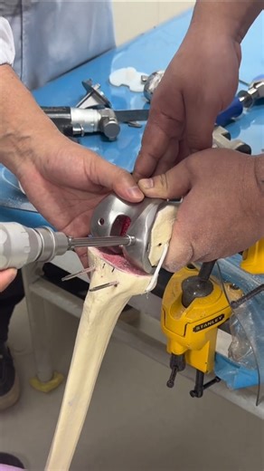 YuanLaiKePu on Instagram: "How artificial hip joints are implanted 人工髋关节是如何安装的 Using anatomical models, this video explains how artificial hip joints replace damaged joints. The procedure restores mobility by combining engineered components with precise positioning. 通过解剖模型演示， 人工髋关节如何替代受损关节。 通过精密设计的组件与准确定位， 帮助患者恢复关节活动能力。 how it works medical implants #howitworks #medicine"