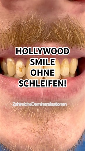 HOLLYWOOD SMILE - Ohne Schleifen mit der Flowable Injection Technique #schönezähne #hollywoodsmile