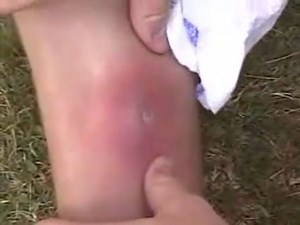 Staph infection popping