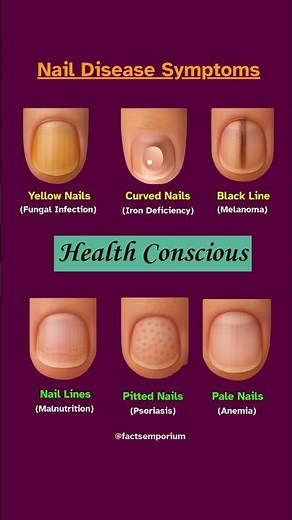 Nail Disease Symptoms | Uncovering Hidden Deficiencies #healthylifestyle #health #healthtips