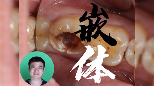 47残冠，嵌体修复