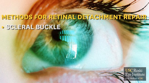USC Roski Eye Institute faculty Dr. Linda Lam breaks down the retina, retinal detachment, and how to correct it. | USC Roski Eye Institute