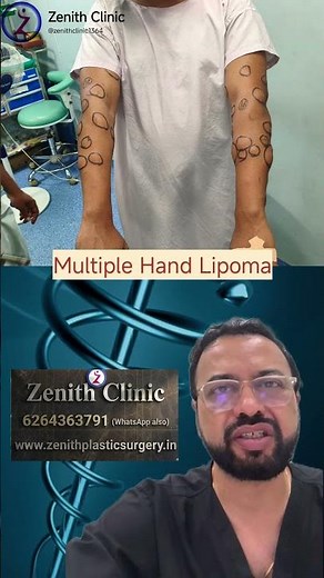 Lipoma removal complete procedure - Mumbai, Bangalore, Indore, Delhi, Pune #lipoma #liposuction