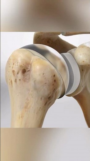 Total shoulder replacement (3D Animation)