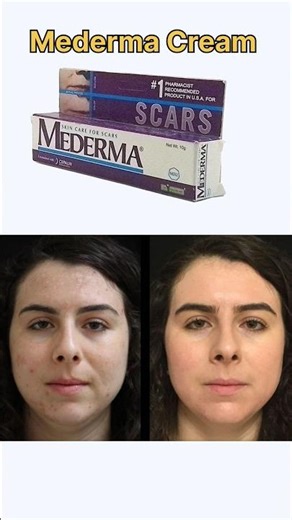 Mederma Cream | mederma advance plus | stretch marks cream #pimple #skincare
