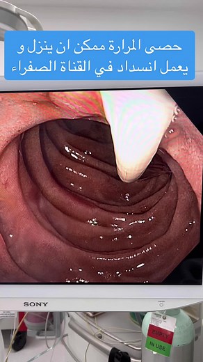 ‏Gall stones can cause a blockage of the bile duct