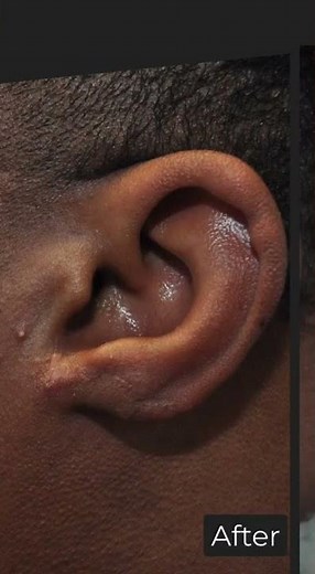 Before and after of an earlobe keloid removal.