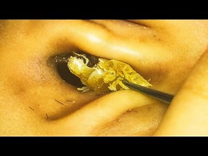 Ear Blockage Solved! Huge Wax Chunk Removed Deep Inside
