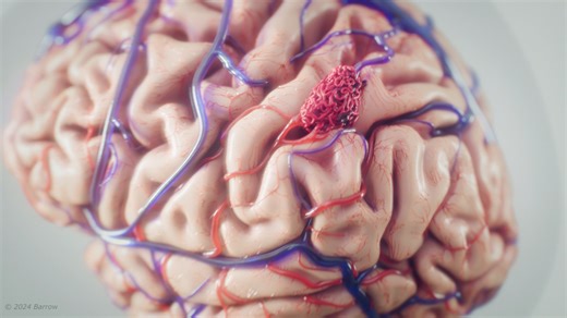 5.7K views · 63 reactions | October is #AVMAwarenessMonth. An #AVM,...