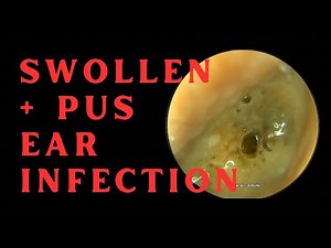 SWOLLEN & PUS FILLED EAR CANAL DUE TO INFECTION!!! (4K 60FPS)