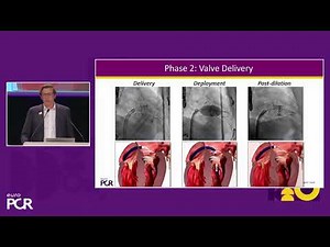Case presentation by Prof. Lurz at EuroPCR: The first commercial case with the SAPIEN M3 system
