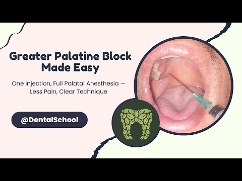 Greater Palatine Nerve Block EXPLAINED | Simple Guide for Effective Palatal Anesthesia