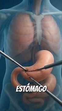 ¿Qué es un Bypass Gástrico y Cómo Funciona?