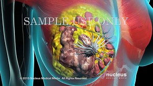 Breast Cancer Tumor Removal Surgery