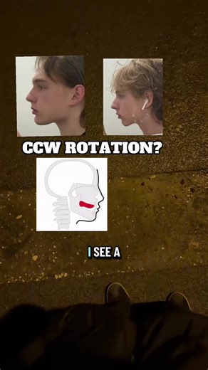 Debunking the CCW Rotation Myth in Mewing
