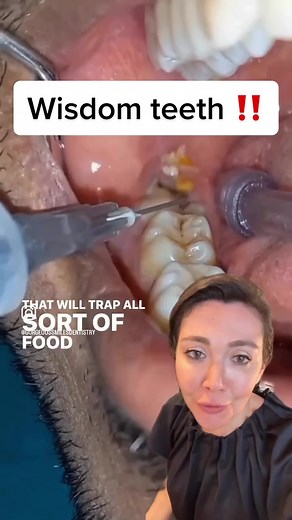 Understanding Pericoronitis and Wisdom Teeth Issues