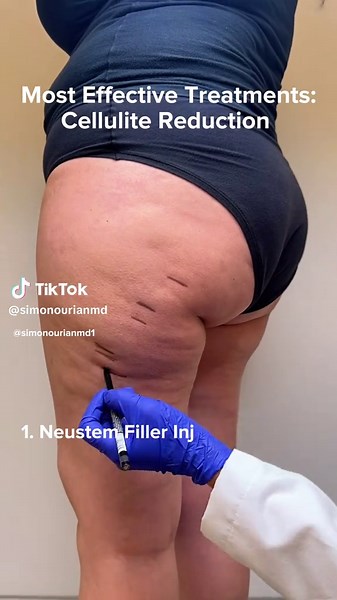 Effective Non-Surgical Cellulite Removal Options