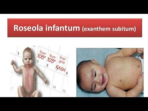 Human Herpes Virus 6 and 7 |Roseola infantum|6th Disease