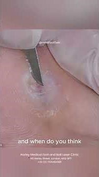 Stubborn Verruca vs. Gouge Blade! by Miss Foot Fixer Marion Yau