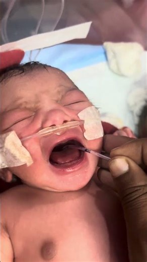 Newborn NG Tube Insertion | How an NG Tube Is Gently Placed in a Baby #NGTubeInsertion