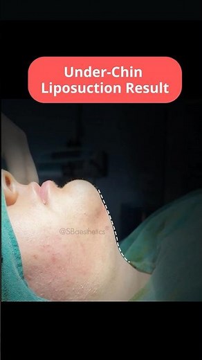 Under Chin Liposuction | Under Chin Fat Removal | Chin Liposuction Before After |SB Aesthetics
