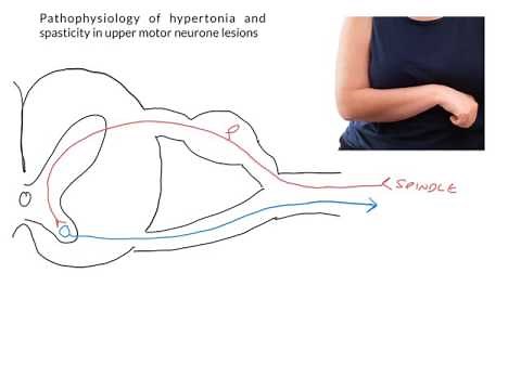 Pathophysiology of spasticity following UMN lesions