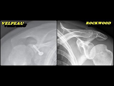 Raio X - Ombro Velpeau e Rockwood