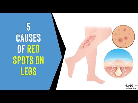5 Causes of Red Spots on Legs