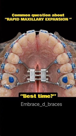 Rapid maxillary expansion! #braces #rme #orthodontist #maxillary expansion