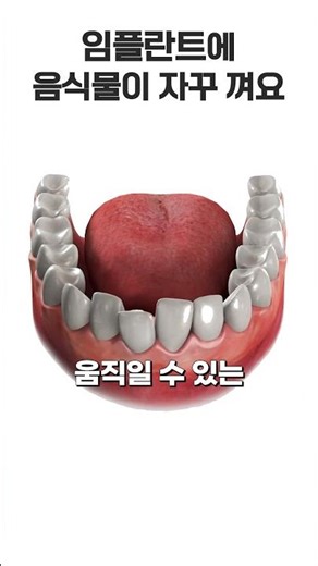 임플란트 했는데 음식물이 자꾸 끼는 이유💦