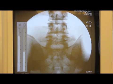 XRayBob C-Arm Overview and Scatter Radiation