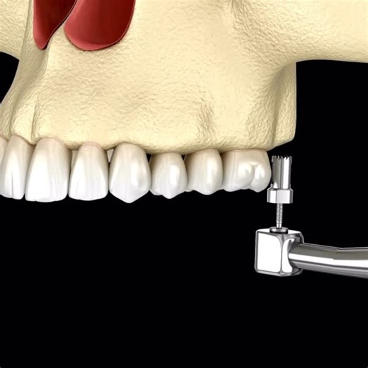 Washington on Instagram: "What is a sinus augmentation? A sinus augmentation, or a sinus lift is a dental procedure that involves adding bone to the upper jaw in the area of the molars and premolars to augment the bone height and create more space for dental implants. It involves lifting the sinus membrane and placing bone graft material underneath it. There are two types. One is a vertical lift that is also known as a Summers sinus lift and with this one in most cases the implants can be placed